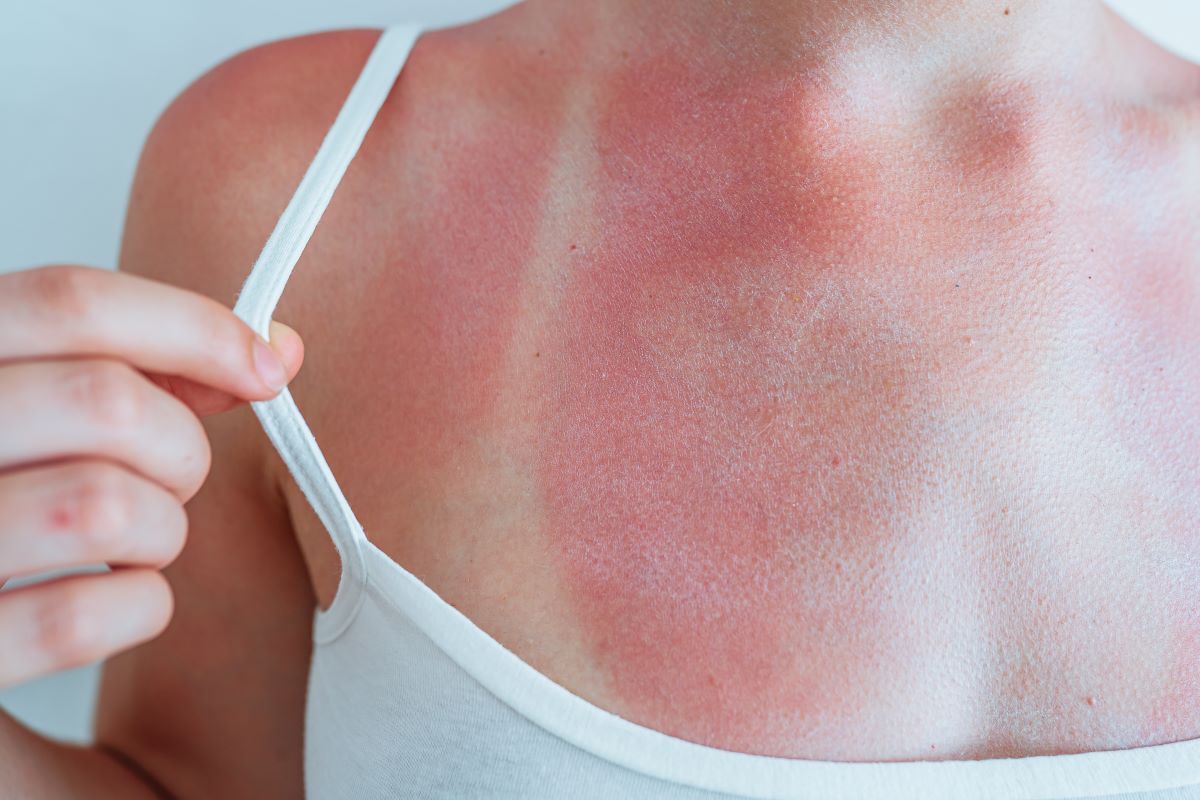 Sonnenbrand in Nordfriesland: Vermeiden, behandeln, ernst ne